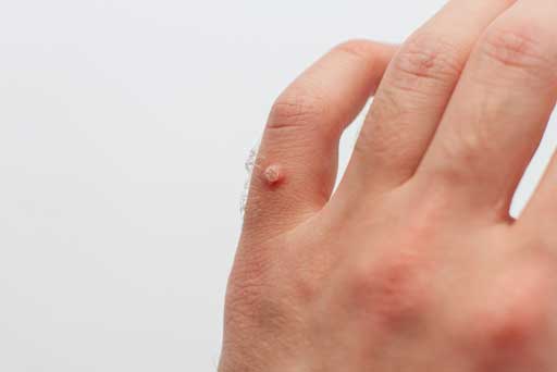 wart removal surrey