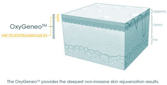 oxygeneo facial surrey