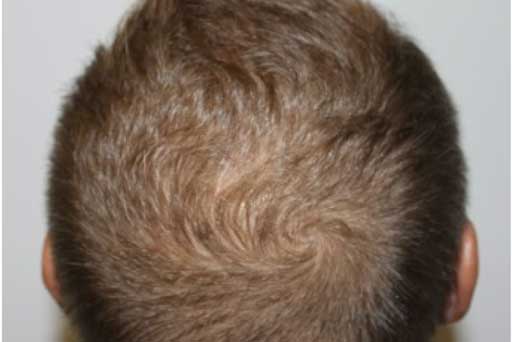 Hair Loss Treatment - Sunetics Laser, HydraFacial Keravive in Surrey, BC