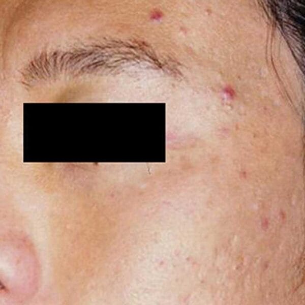 Skin Pigmentation Treatment - Laser, Chemicals Peels, Microneedling