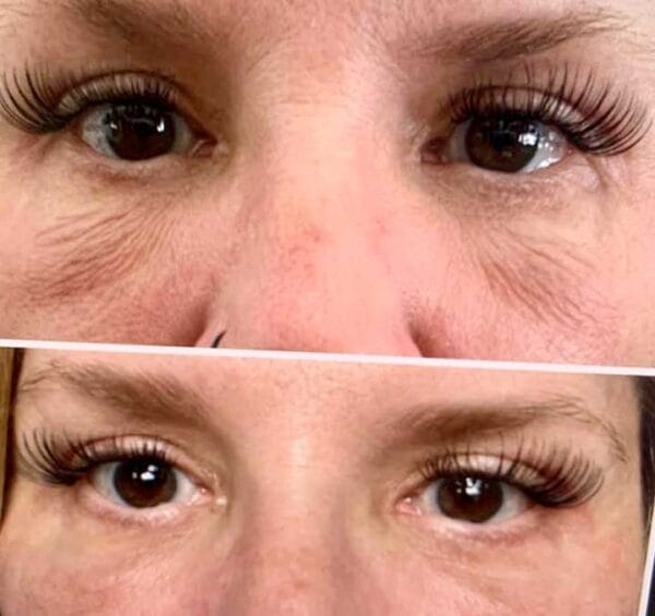 Eye Peel | Intense Treatment - Ageless Beauty Laser & Spa