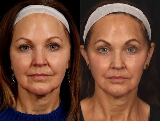 Before-and-after photos from an anti-aging facial
