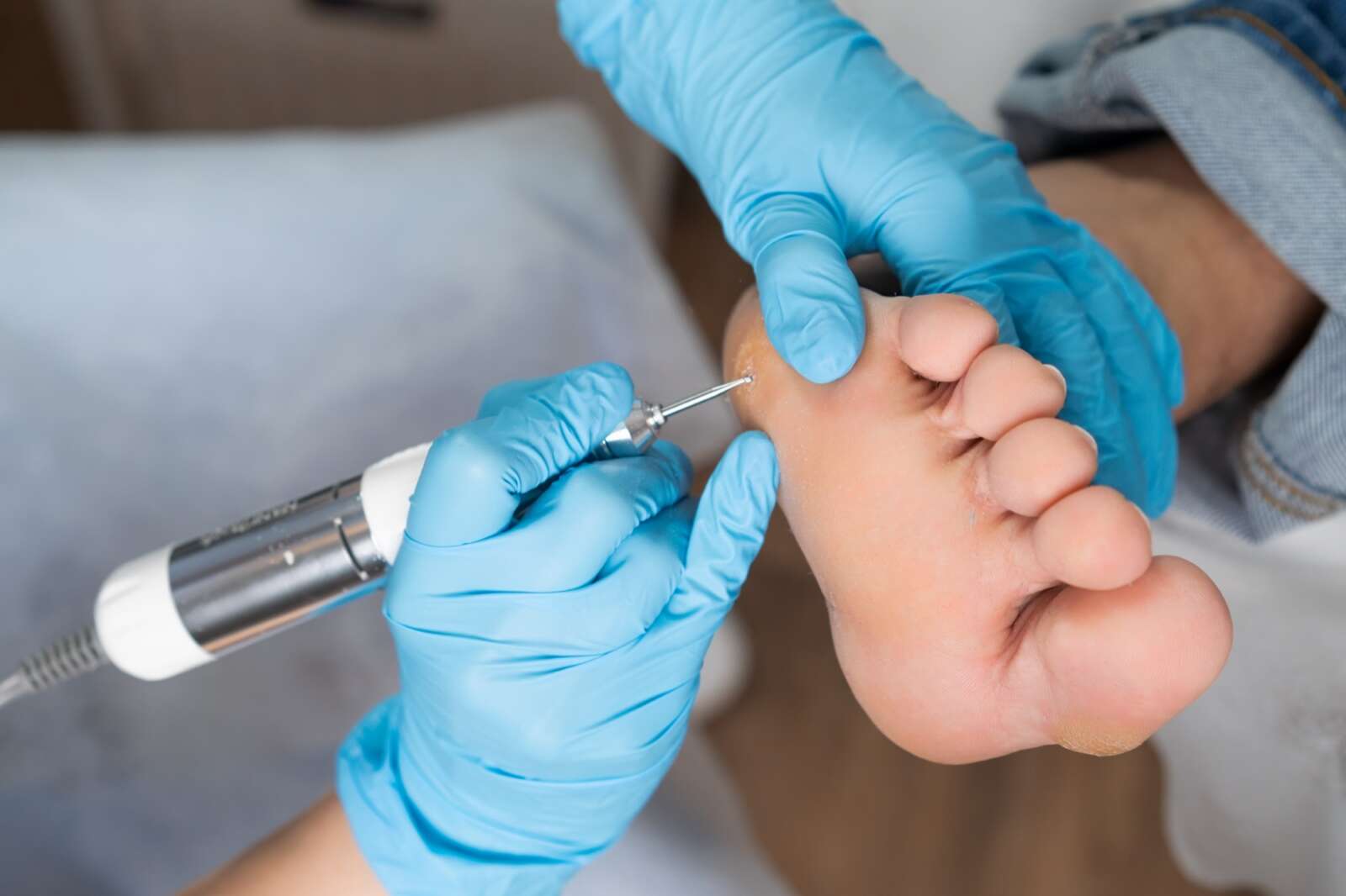 Warts assessment at Ageless Beauty Surrey