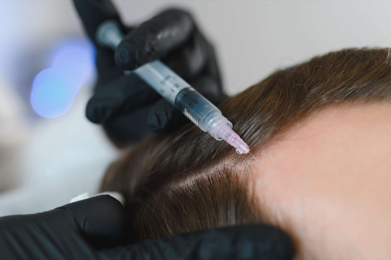 Treating hair loss in Surrey