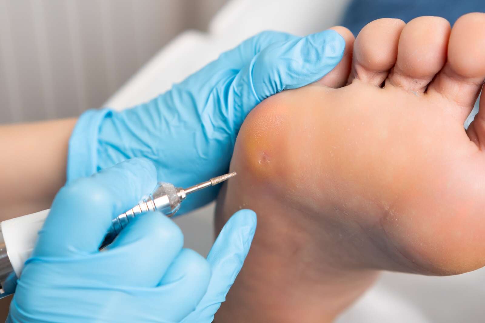 Warts Treatment at Ageless Beauty Laser & Spa in Surrey