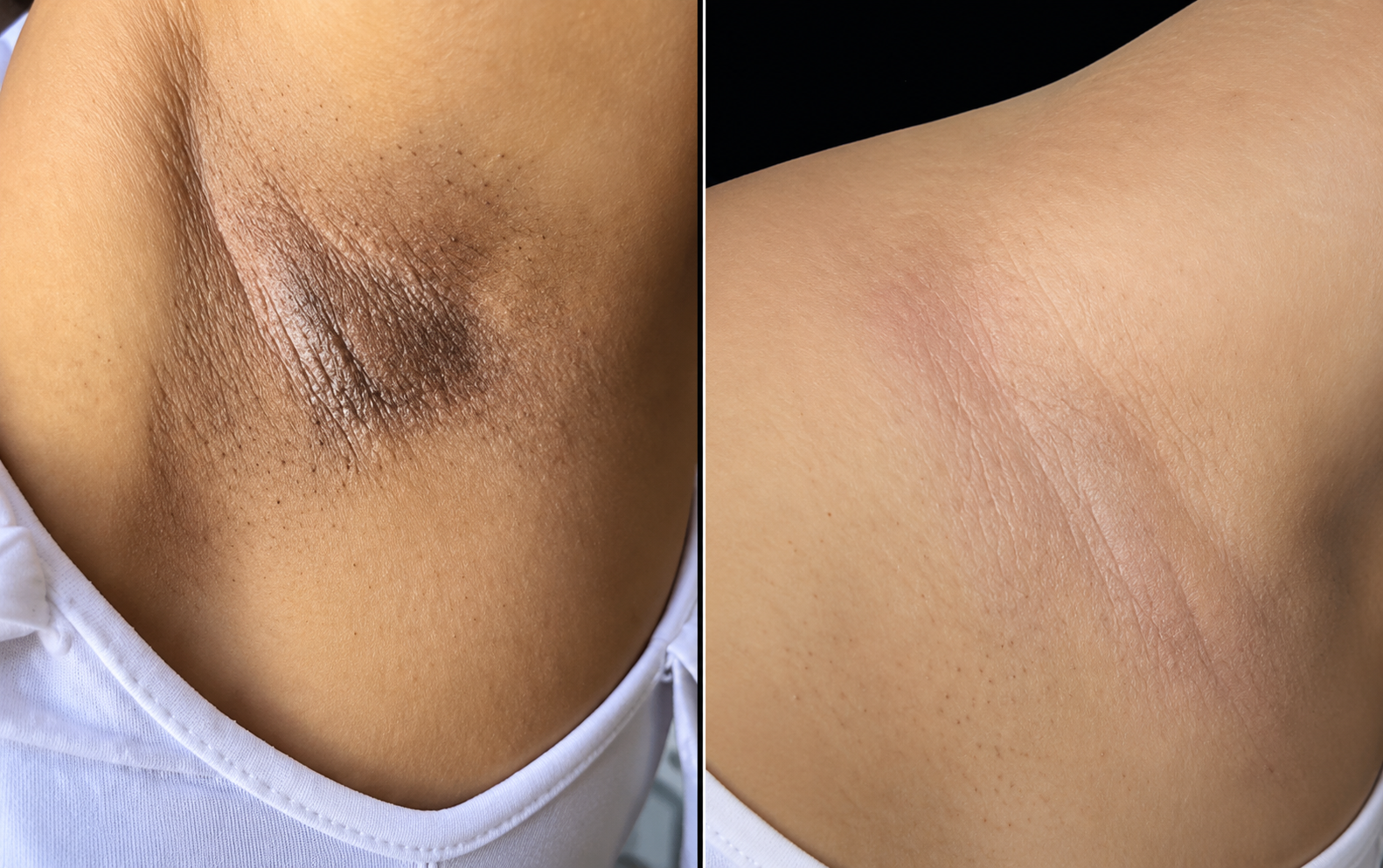 Underarm skin tone comparison