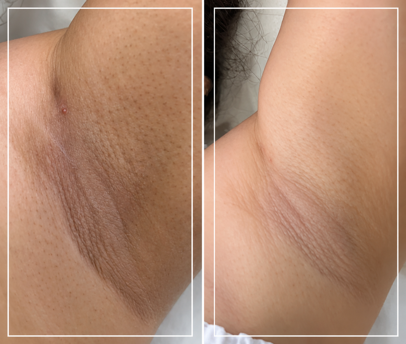 Underarm skin tone comparison