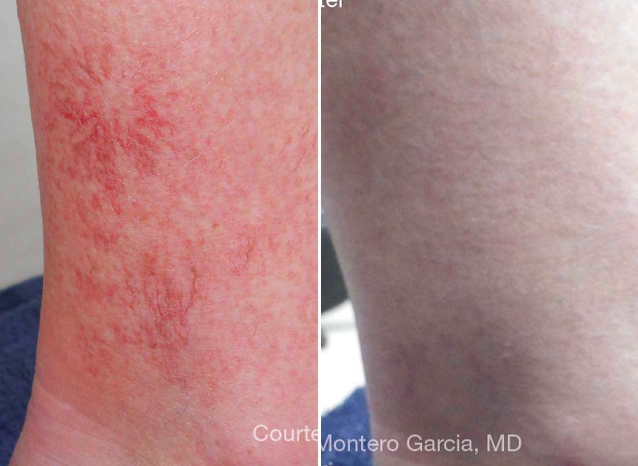 Vascular vein treatment before and after at Ageless Beauty