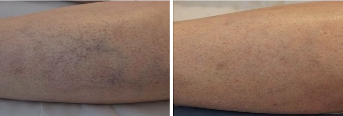 Individual results before and after