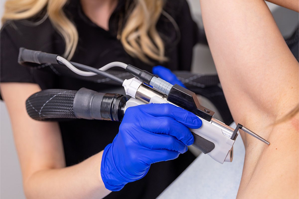 Elite iQ laser hair removal treatment at Ageless Beauty Laser & Spa, Surrey