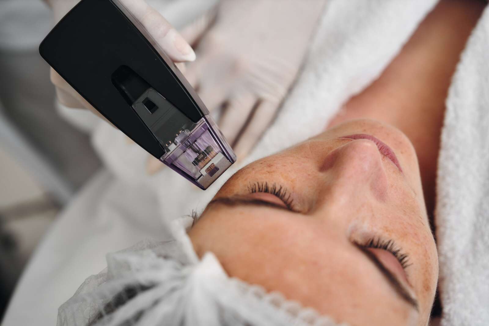 Morpheus8 RF microneedling treatment at Ageless Beauty Laser & Spa